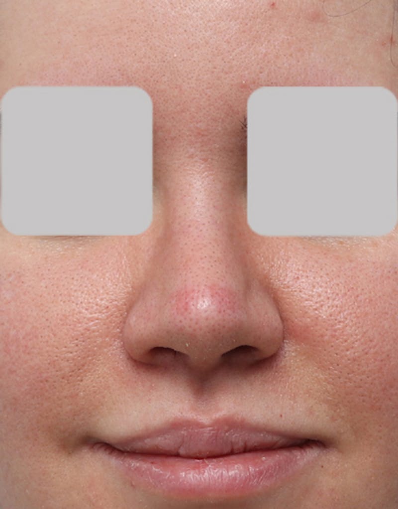 Rhinoplasty  Before & After Gallery - Patient 323363 - Image 4