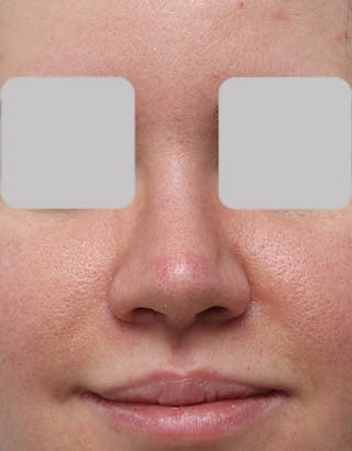 Rhinoplasty Before & After Gallery - Patient 323363 - Image 4