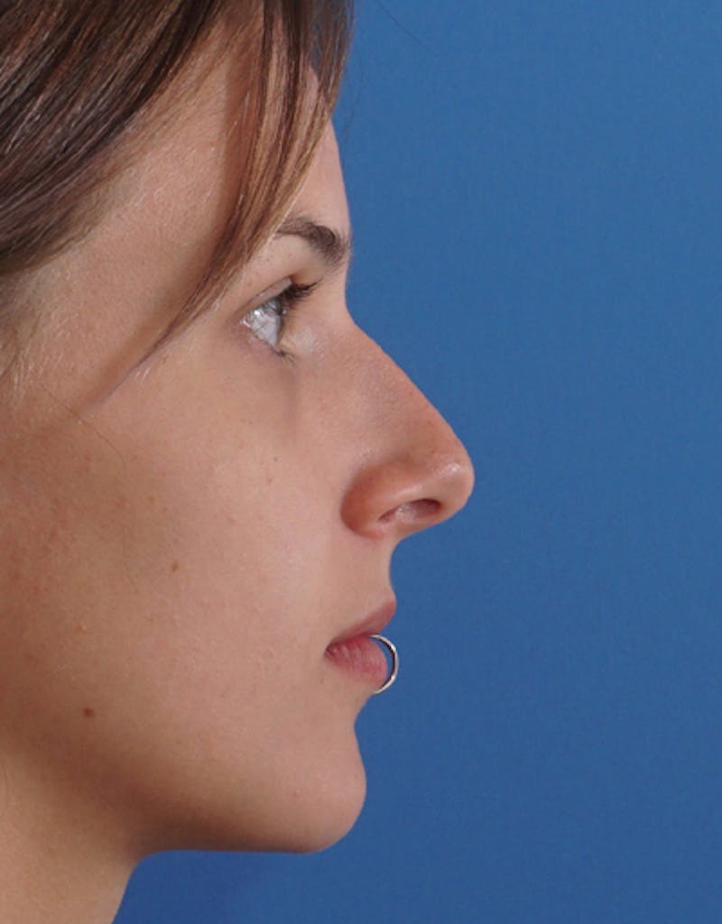 Rhinoplasty Before & After Gallery - Patient 557951 - Image 1