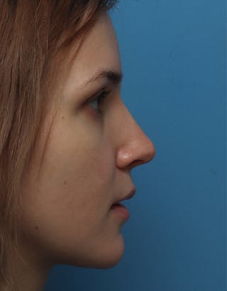 Favorite Rhinoplasty Before & After Gallery - Patient 709017 - Image 2