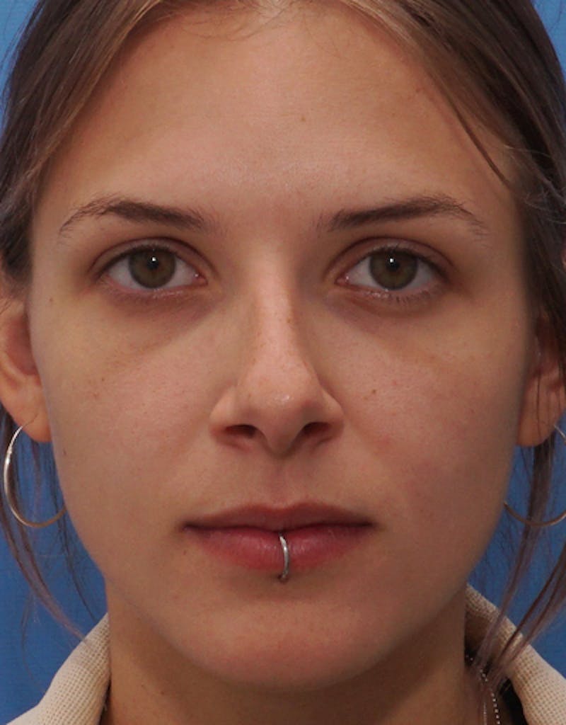 Rhinoplasty Before & After Gallery - Patient 557951 - Image 3