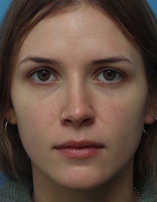 Favorite Rhinoplasty Before & After Gallery - Patient 709017 - Image 4