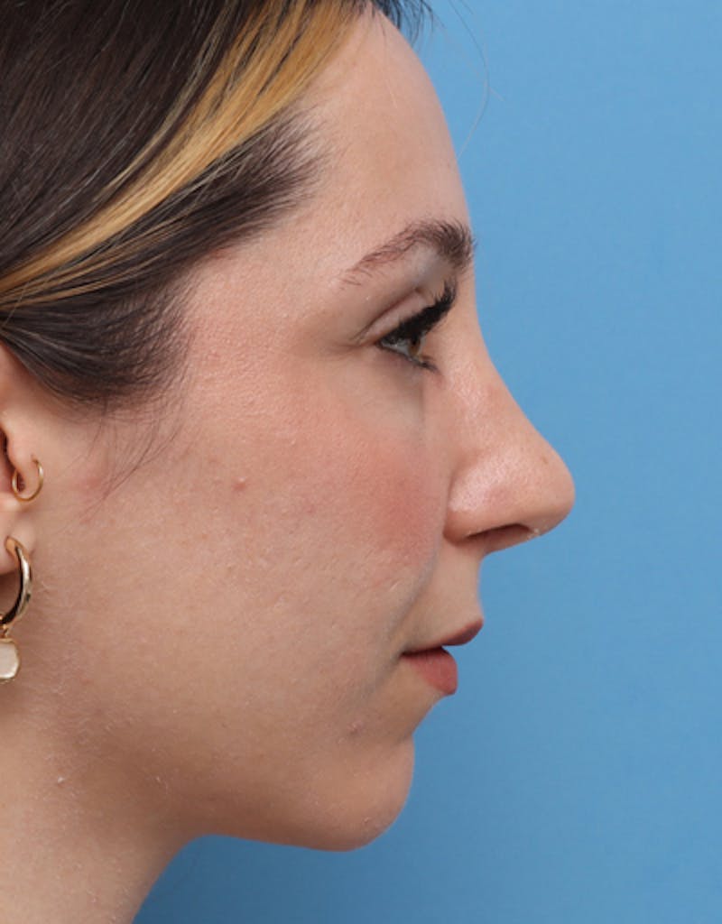 Rhinoplasty Before & After Gallery - Patient 143151 - Image 2