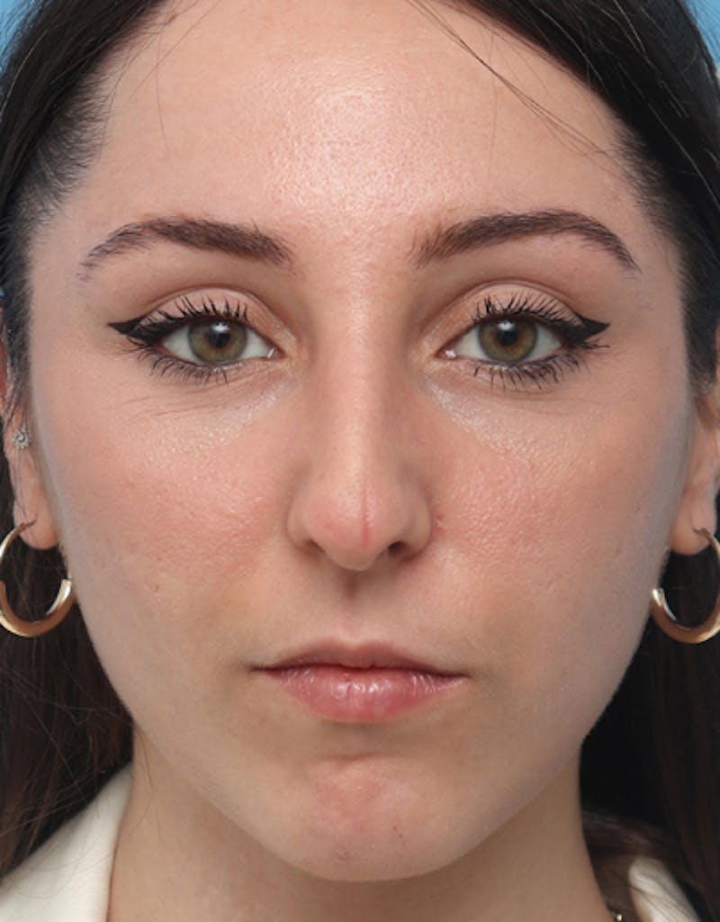 Rhinoplasty Before & After Gallery - Patient 143151 - Image 3