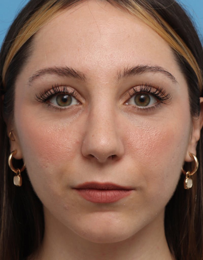 Rhinoplasty  Before & After Gallery - Patient 345997 - Image 4
