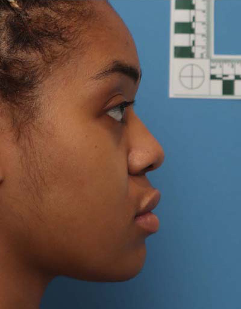 Patient QJ35F0N0QNaPHJlXL98DEg - Ethnic Rhinoplasty Before & After Photos