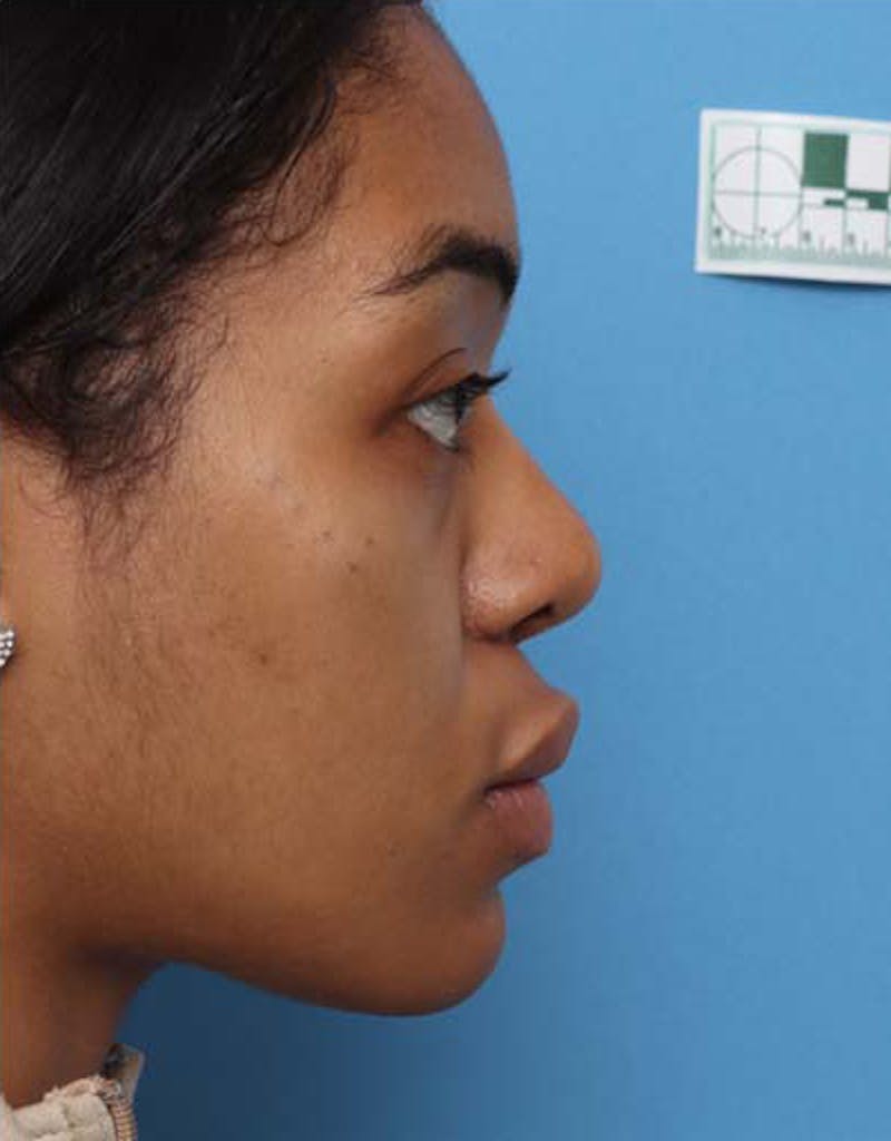 Rhinoplasty Before & After Gallery - Patient 233702 - Image 2