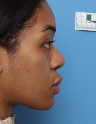 Rhinoplasty Before & After Gallery - Patient 146161 - Image 2