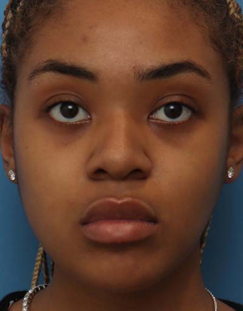 Rhinoplasty Before & After Gallery - Patient 233702 - Image 3