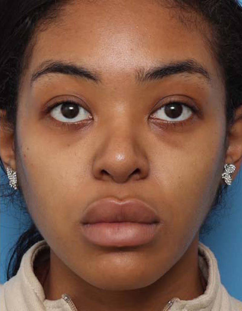 Rhinoplasty Before & After Gallery - Patient 233702 - Image 4