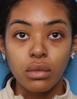 Rhinoplasty Before & After Gallery - Patient 146161 - Image 4