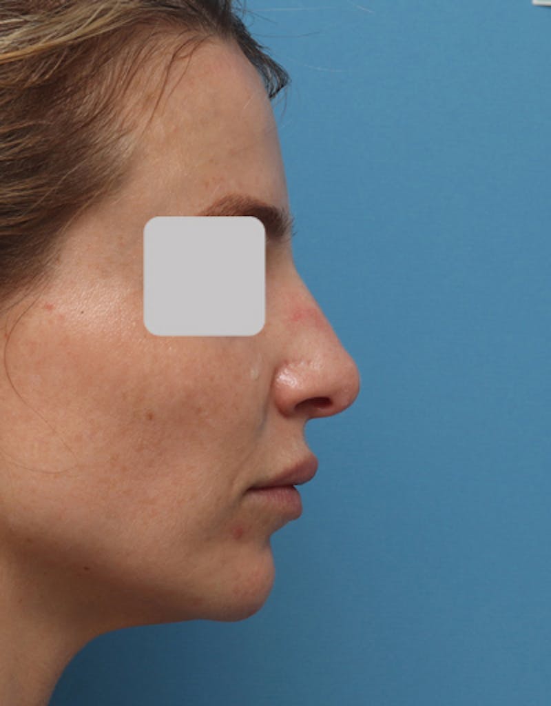 Patient LAqHU69BSICFBKFtZ9mpew - Rhinoplasty Before & After Photos