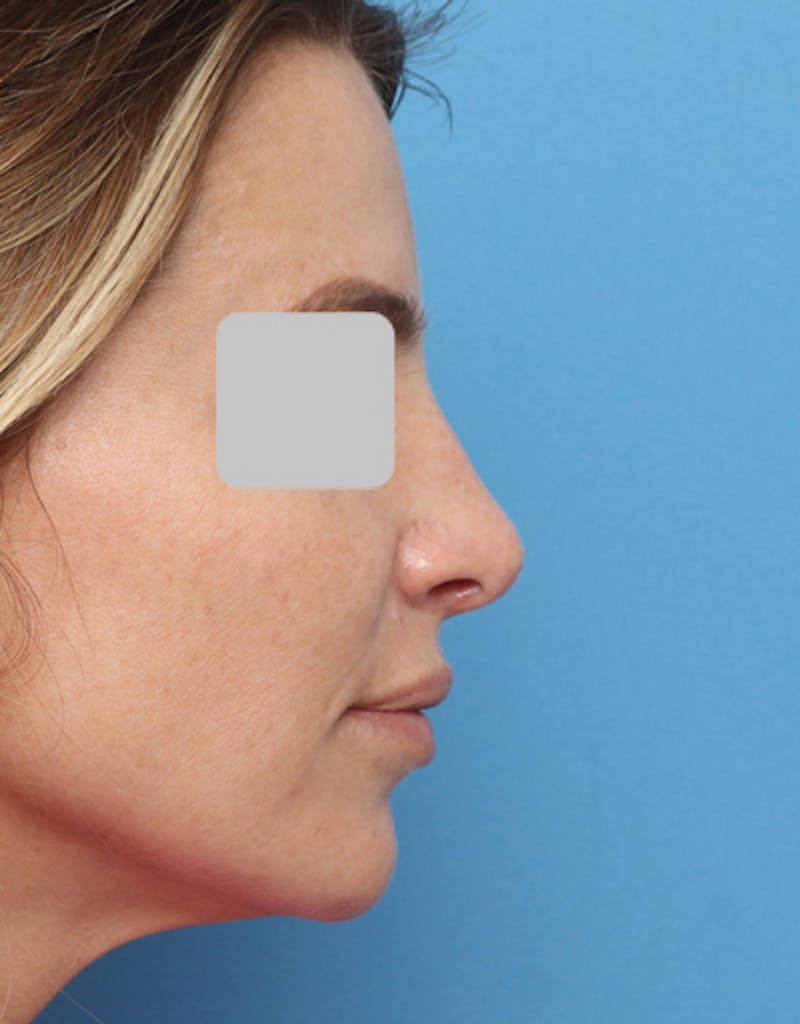 Rhinoplasty Before & After Gallery - Patient 451488 - Image 2
