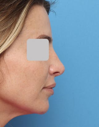 Rhinoplasty Before & After Gallery - Patient 325293 - Image 2