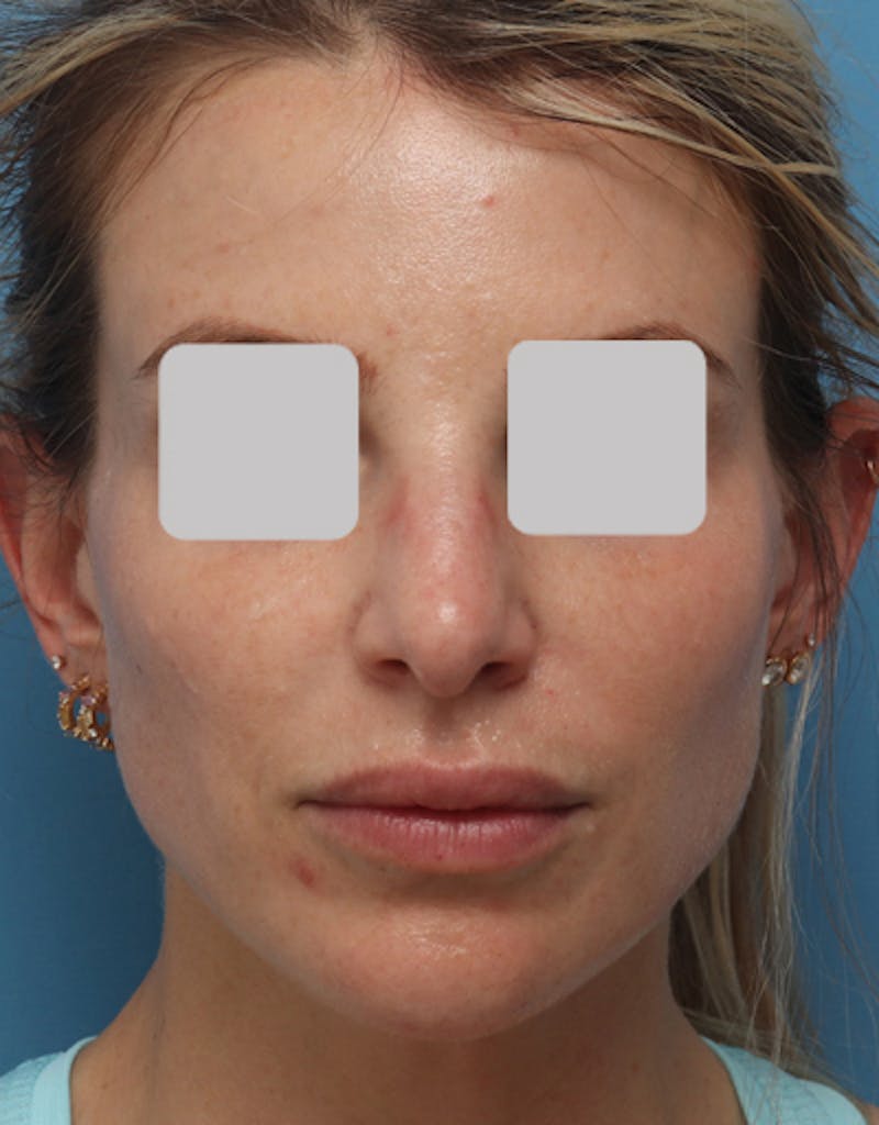 Rhinoplasty  Before & After Gallery - Patient 325293 - Image 3