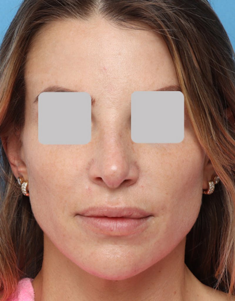 Rhinoplasty  Before & After Gallery - Patient 325293 - Image 4