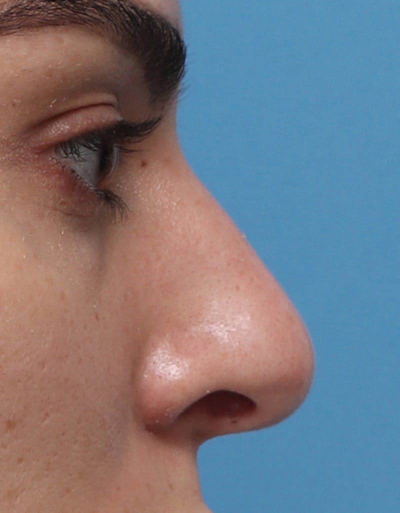Rhinoplasty Before & After Gallery - Patient 210523 - Image 1