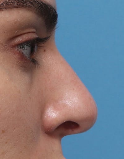 Rhinoplasty Before & After Gallery - Patient 402359 - Image 1