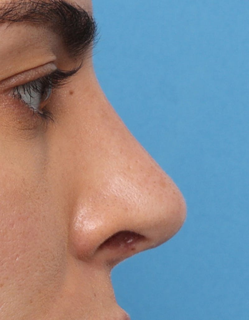 Rhinoplasty Before & After Gallery - Patient 210523 - Image 2