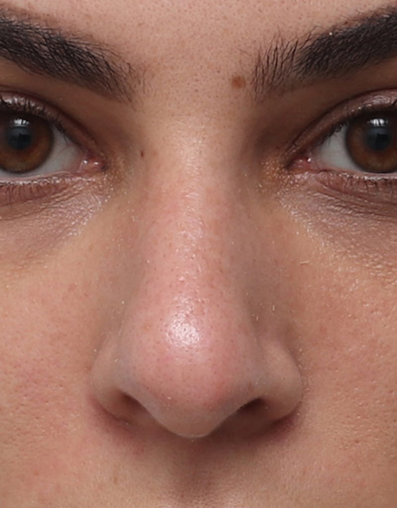 Rhinoplasty Before & After Gallery - Patient 210523 - Image 3