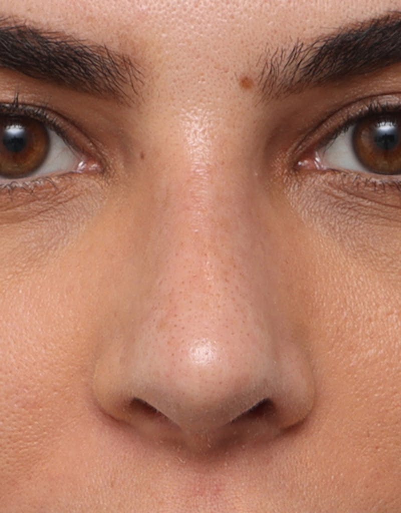 Rhinoplasty Before & After Gallery - Patient 210523 - Image 4