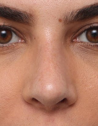 Rhinoplasty Before & After Gallery - Patient 402359 - Image 4