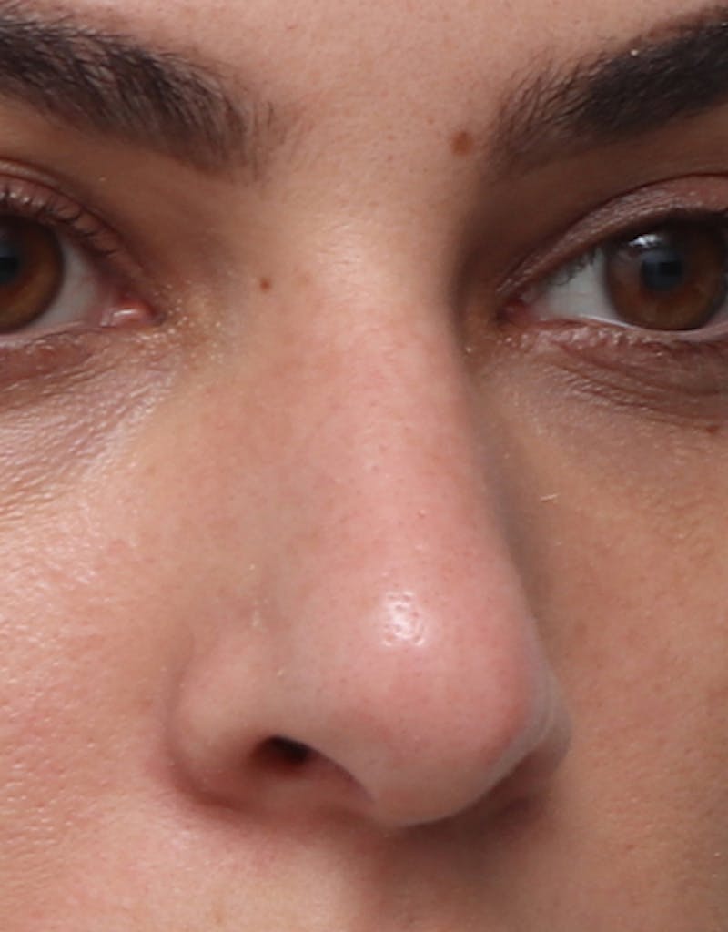 Rhinoplasty Before & After Gallery - Patient 210523 - Image 5