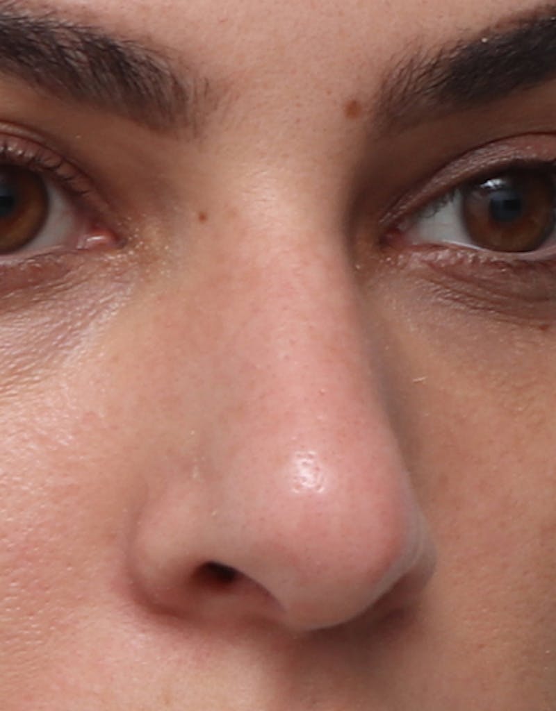 Rhinoplasty  Before & After Gallery - Patient 402359 - Image 5