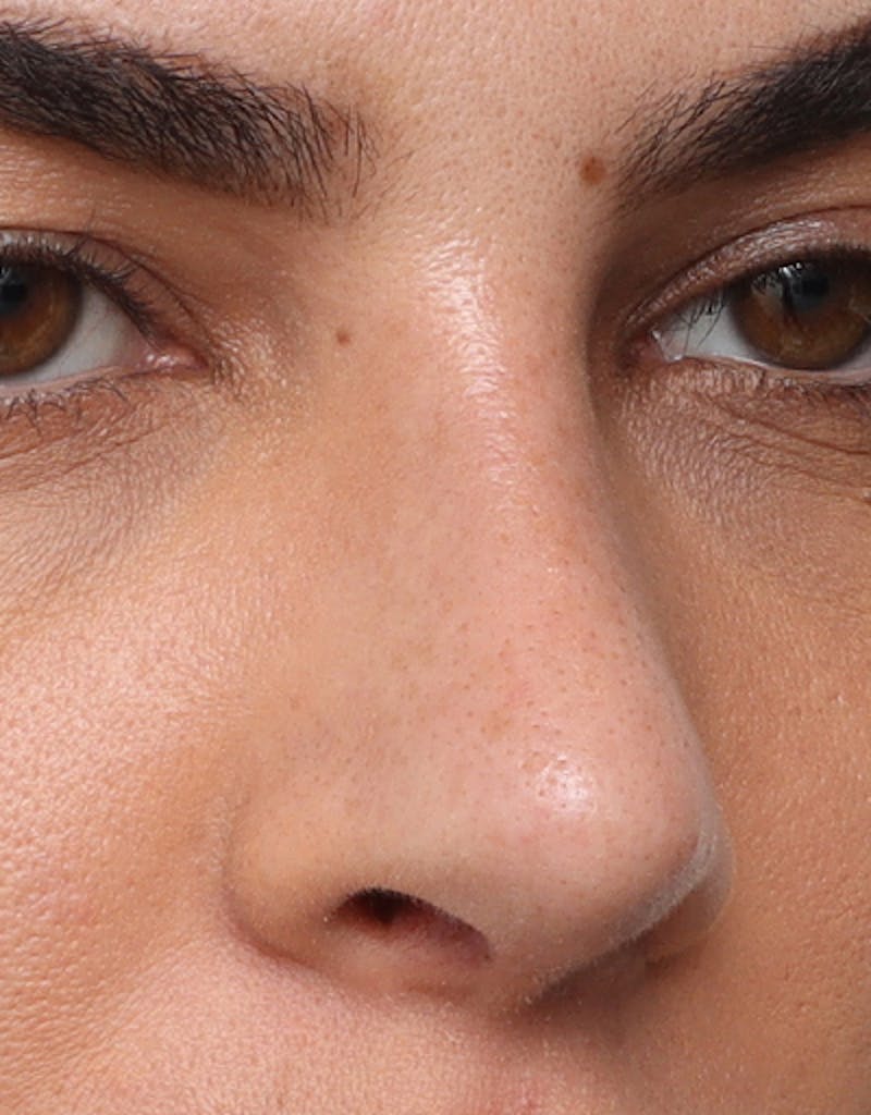 Rhinoplasty Before & After Gallery - Patient 210523 - Image 6