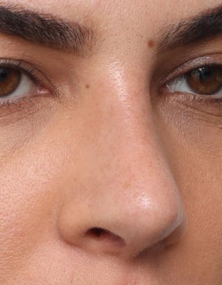 Rhinoplasty Before & After Gallery - Patient 402359 - Image 6