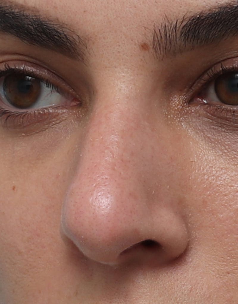 Rhinoplasty Before & After Gallery - Patient 210523 - Image 7