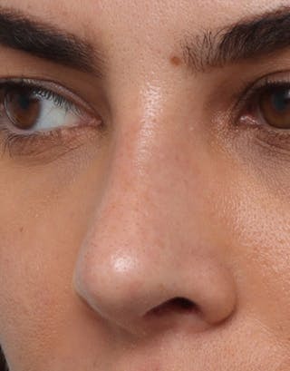Rhinoplasty Before & After Gallery - Patient 402359 - Image 8