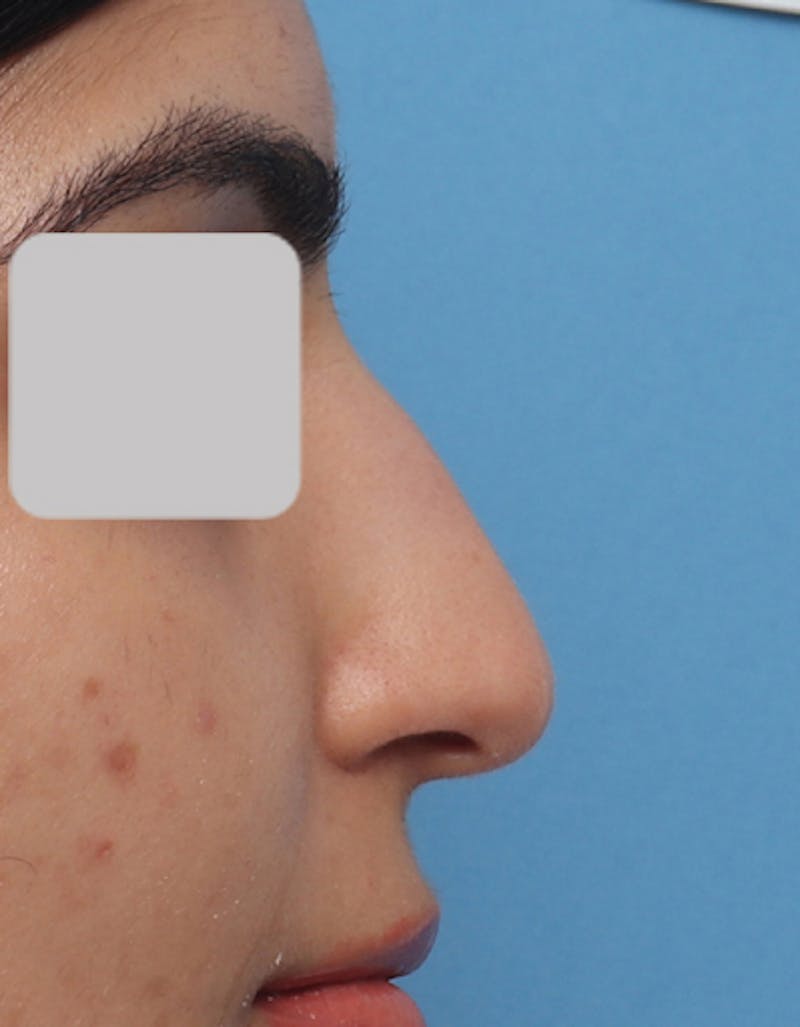 Patient bCJZfaAATwyQhXe-BhDlwg - Rhinoplasty Before & After Photos