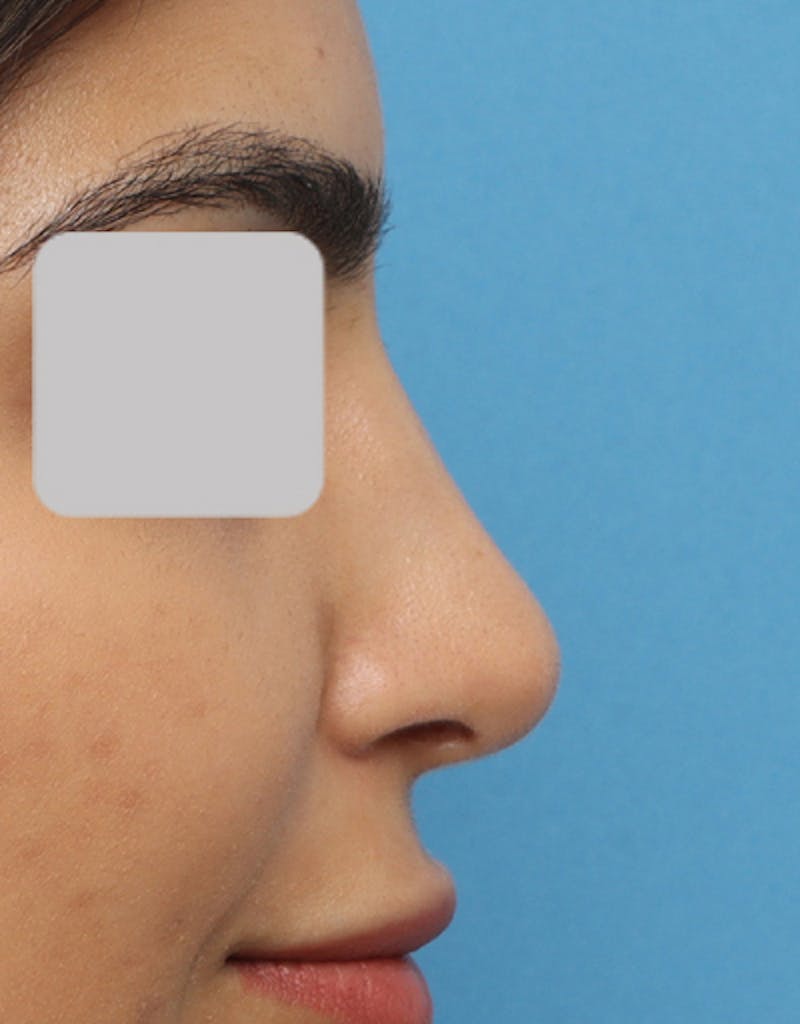 Rhinoplasty Before & After Gallery - Patient 382113 - Image 2