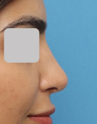 Rhinoplasty Before & After Gallery - Patient 770589 - Image 2