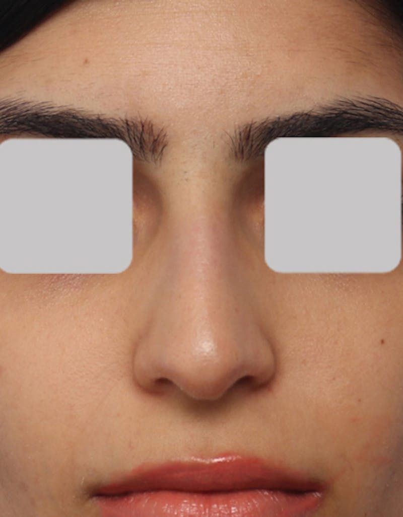 Rhinoplasty Before & After Gallery - Patient 382113 - Image 3