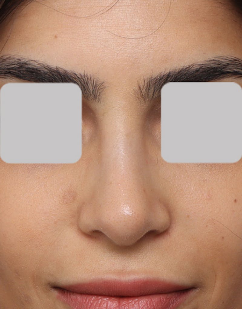 Rhinoplasty  Before & After Gallery - Patient 770589 - Image 4