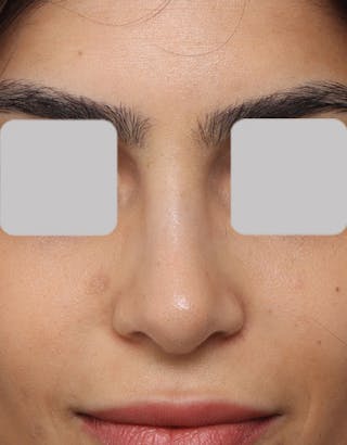 Rhinoplasty Before & After Gallery - Patient 770589 - Image 4