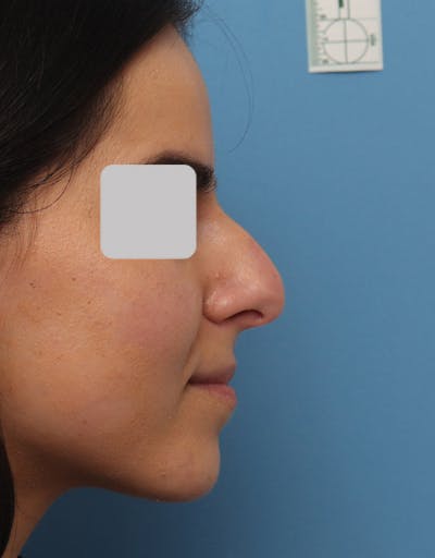 Rhinoplasty Before & After Gallery - Patient 343312 - Image 1