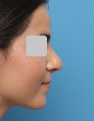 Rhinoplasty Before & After Gallery - Patient 343312 - Image 2