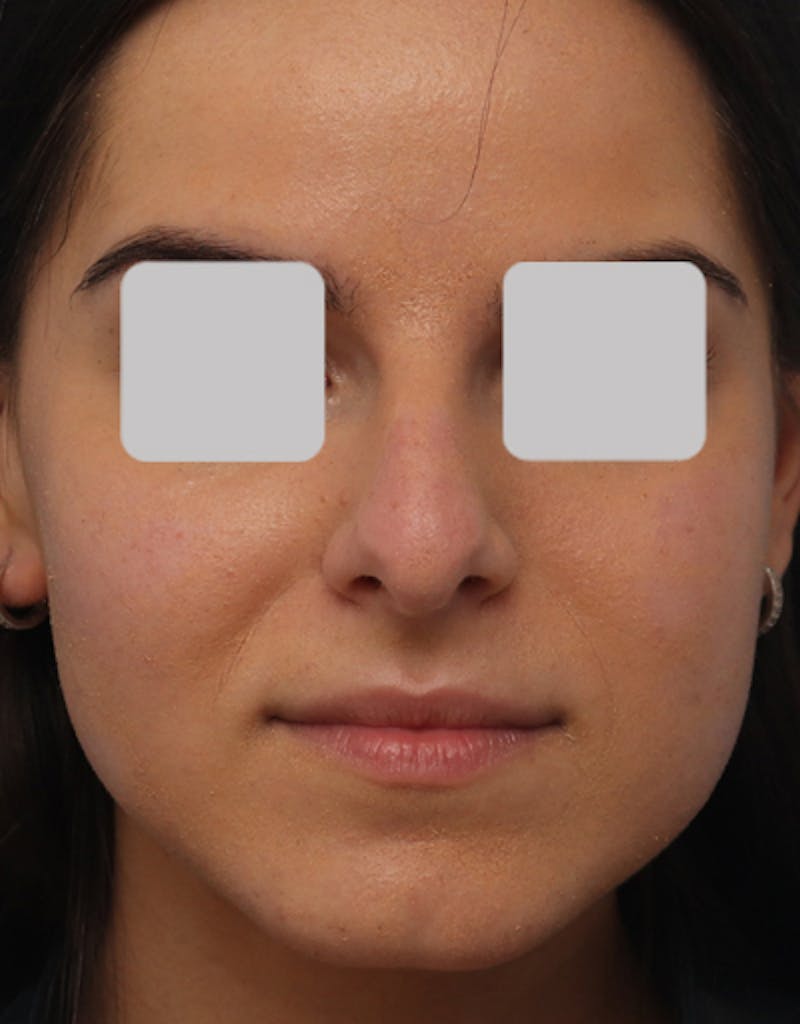 Rhinoplasty  Before & After Gallery - Patient 343312 - Image 3