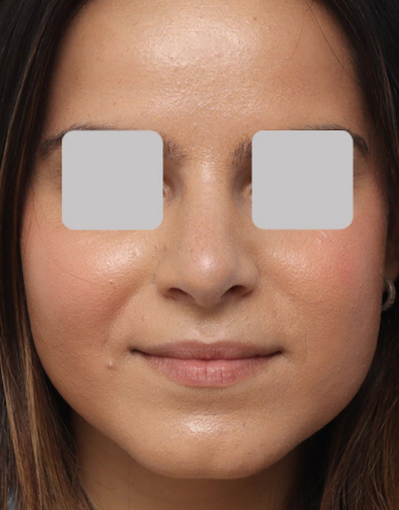 Rhinoplasty  Before & After Gallery - Patient 343312 - Image 4