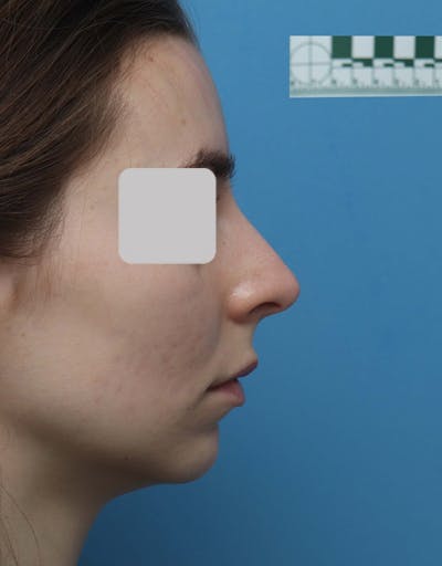 Rhinoplasty Before & After Gallery - Patient 337607 - Image 1