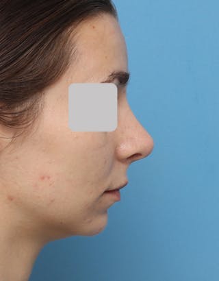 Rhinoplasty Before & After Gallery - Patient 337607 - Image 2