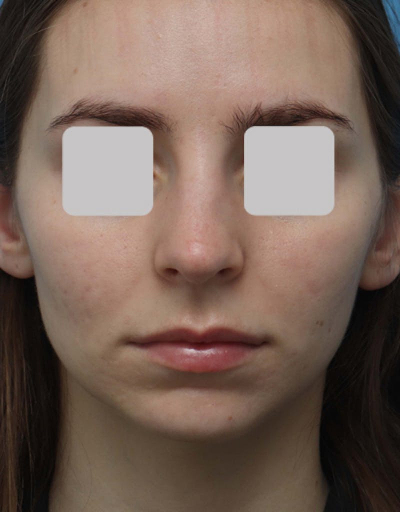 Rhinoplasty  Before & After Gallery - Patient 337607 - Image 3