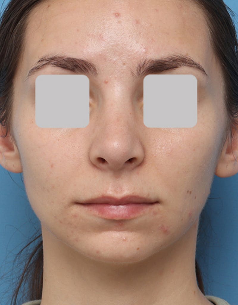 Rhinoplasty Before & After Gallery - Patient 616684 - Image 4
