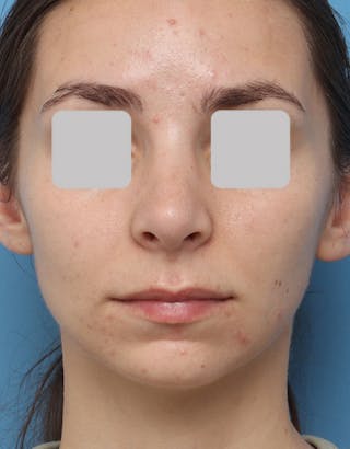Rhinoplasty Before & After Gallery - Patient 337607 - Image 4