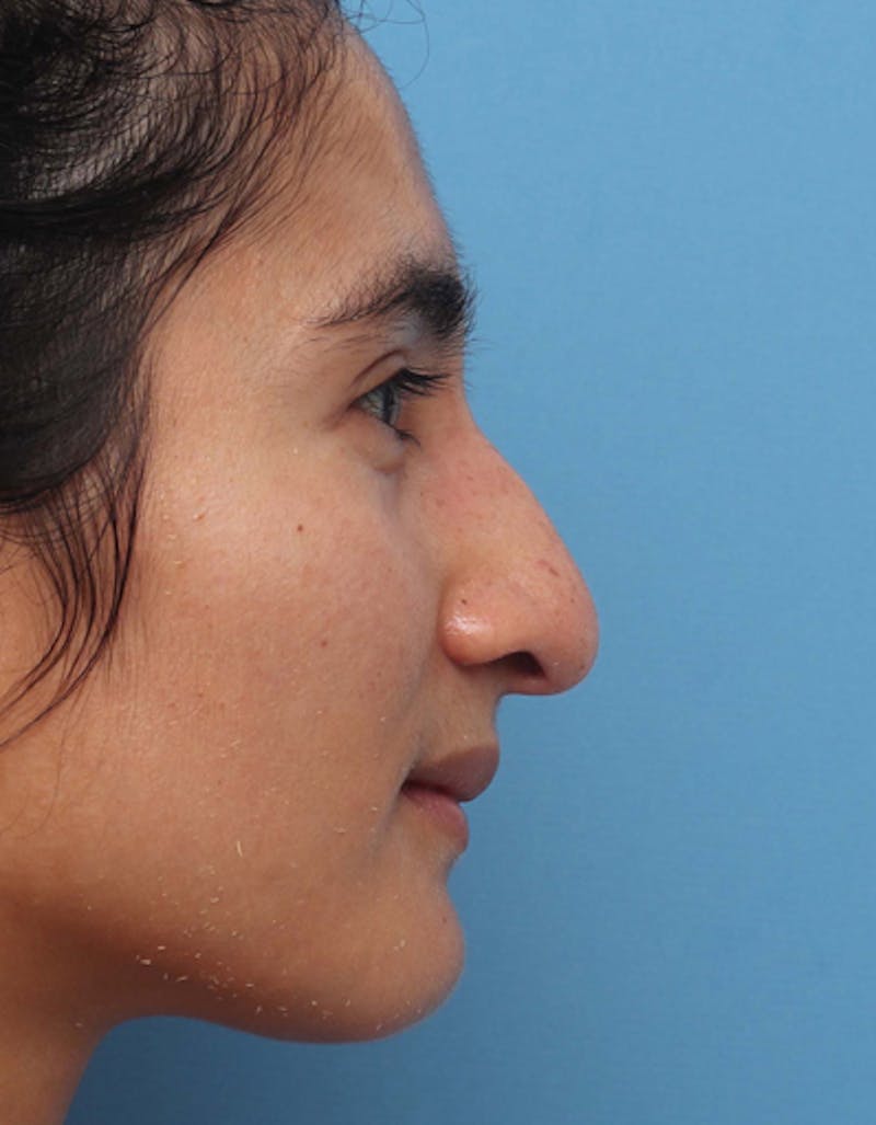 Rhinoplasty Before & After Gallery - Patient 189861 - Image 1