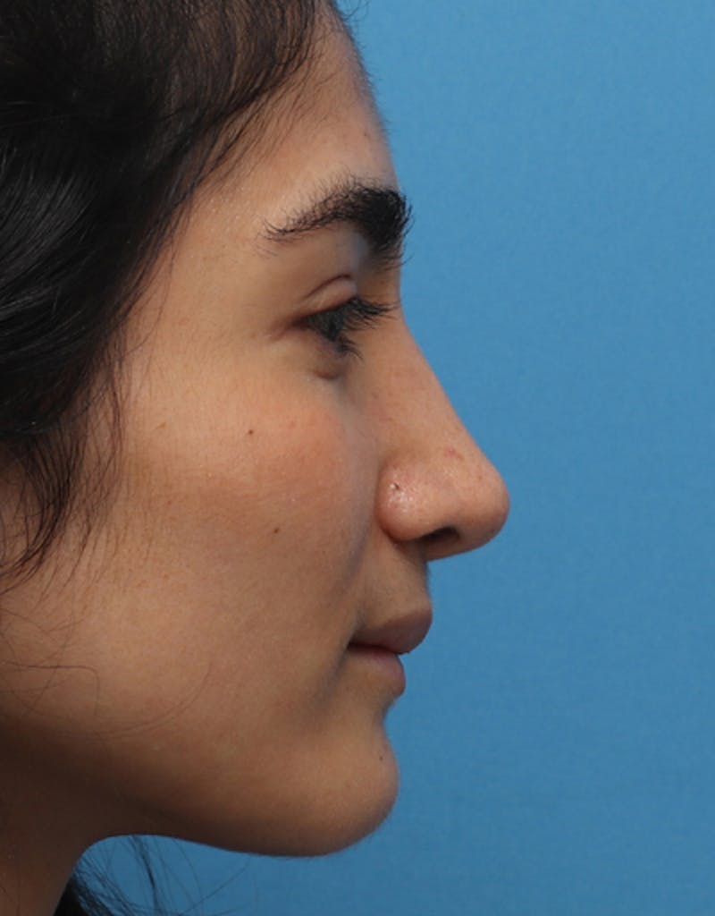 Rhinoplasty Before & After Gallery - Patient 189861 - Image 2