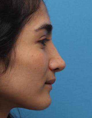 Rhinoplasty Before & After Gallery - Patient 194204 - Image 2